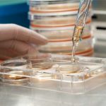 Sclerosi multipla, investimenti nella ricerca ancora insufficienti