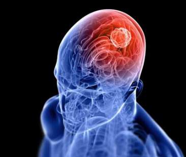 Ictus, cure inadeguate nel 40% dei casi