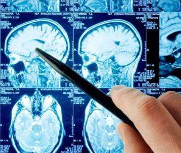 Tumori al cervello, 4.500 nuovi casi l’anno