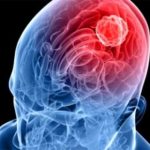 Meningite, no all’allarmismo facile