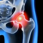 Il conflitto femoro-acetabolare malattia dell’anca molto diffusa