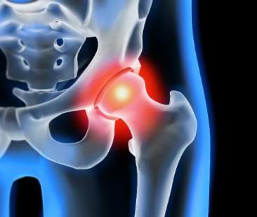 Il conflitto femoro-acetabolare malattia dell’anca molto diffusa Il conflitto femoro-acetabolare malattia dell’anca molto diffusa