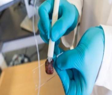 Una penna per diagnosticare i tumori in soli dieci secondi Una penna per diagnosticare i tumori in soli dieci secondi