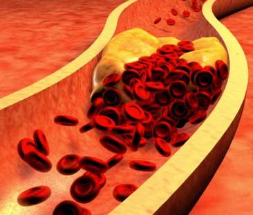 Ipercolesterolomia e rischi cardiovascolari, terapie innovative a supporto dei pazienti Ipercolesterolomia e rischi cardiovascolari, terapie innovative a supporto dei pazienti