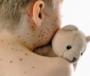 Eradicare in tempi rapidi il virus del morbillo evitando reciproci contagi incrociati tra Paesi