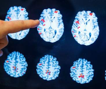 Sclerosi multipla, uno studio per identificare tempestivamente le strategie terapeutiche