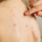Vaccini: Morbillo, 557 casi in primi tre mesi 2019 in Italia