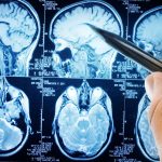 Sanità, in Italia poche le regioni a misura di epilessia:  criticità legate soprattutto all’assistenza e all’accesso ai farmaci