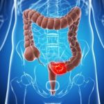 Prevenzione del tumore al colon-retto, campagna informativa dell’Asp 8