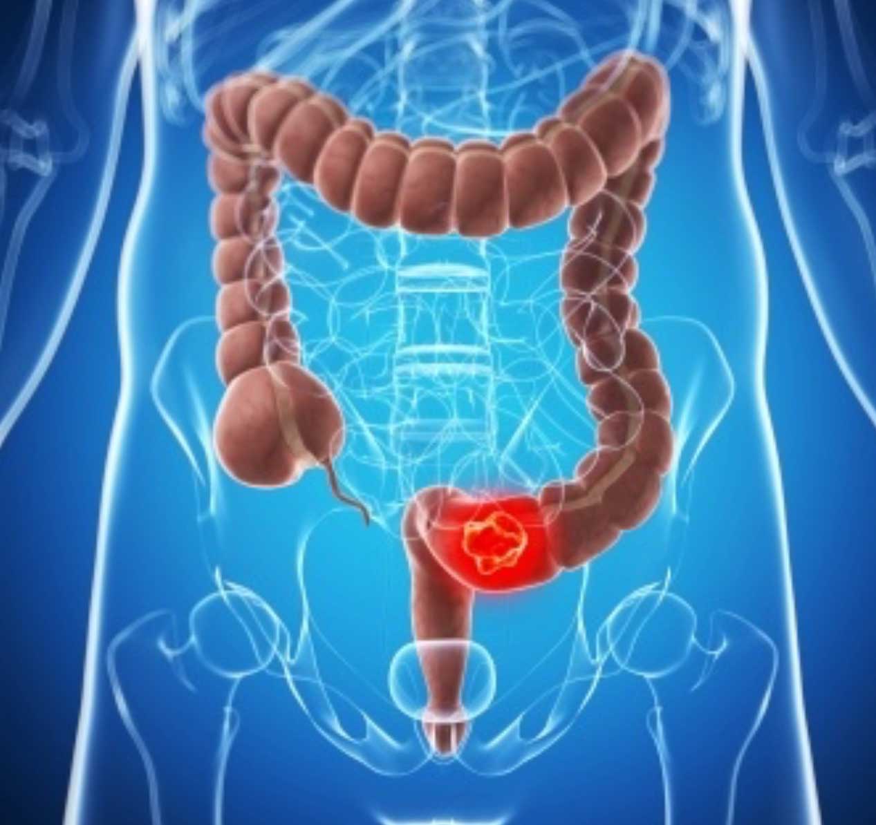 Prevenzione del tumore al colon-retto, campagna informativa dell’Asp 8 Prevenzione del tumore al colon-retto, campagna informativa dell’Asp 8