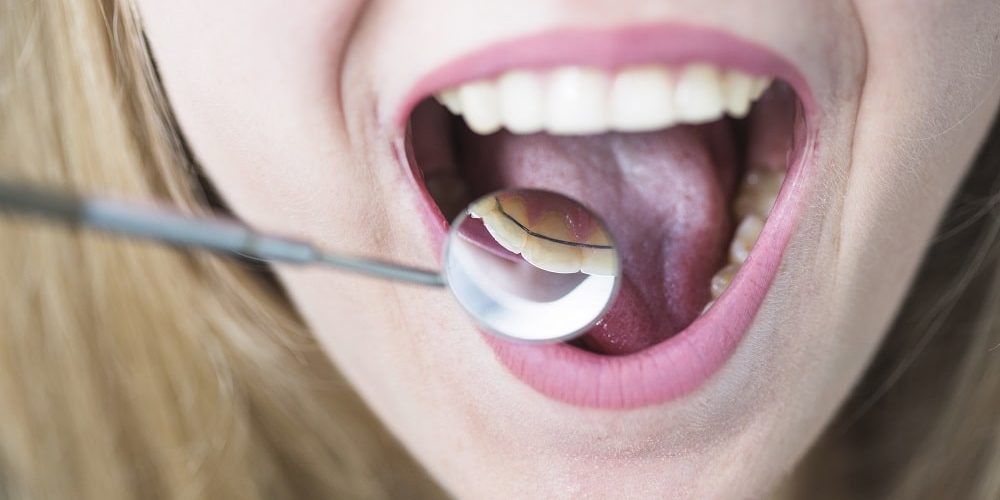 Allarme degli esperti sui tumori orofaringei in dieci anni casi aumentati di circa il 300%