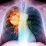 Tumore al polmone, un mix di terapie riduce il rischio di morte, ecco quali
