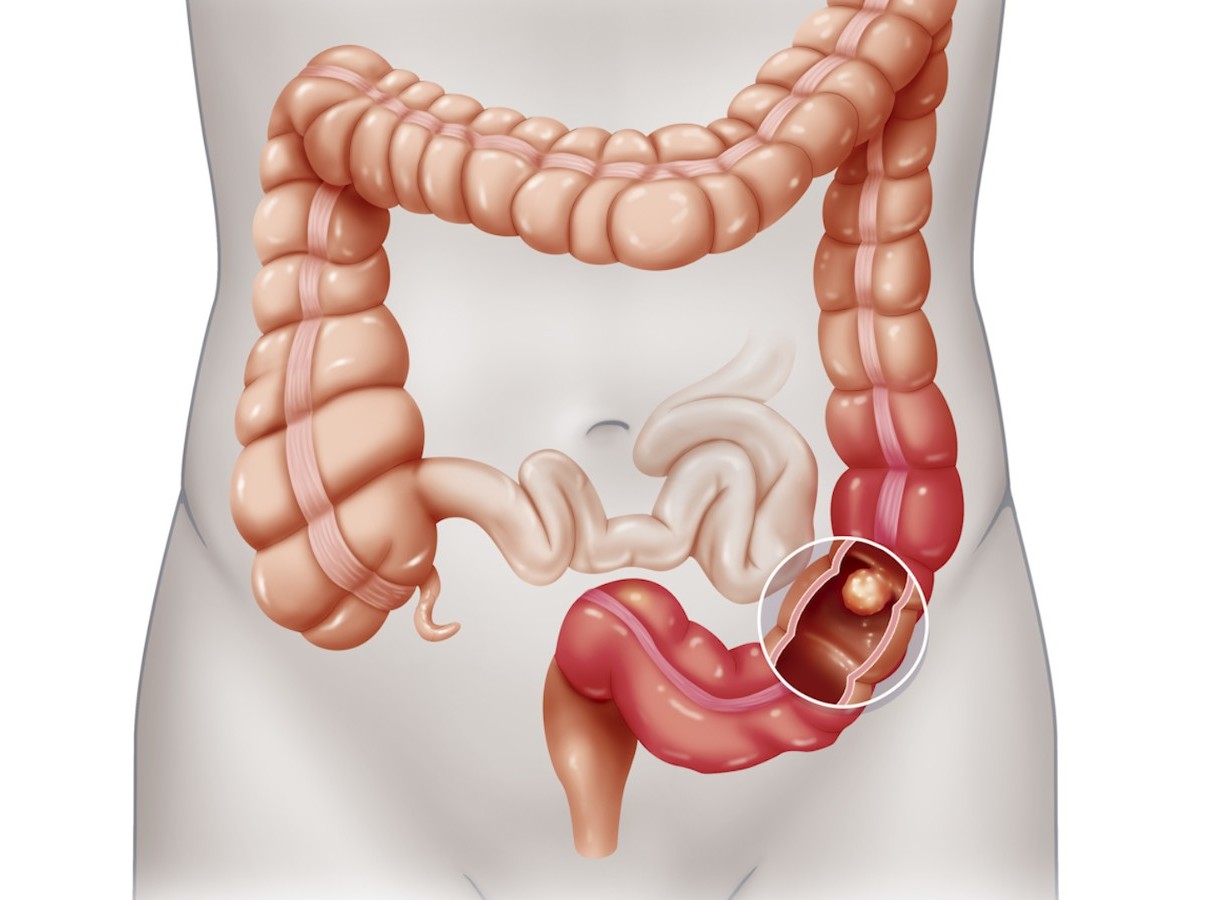 Tumori, studio su cellule dormienti apre nuove speranze per le terapie