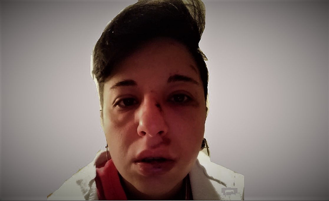 Pestata a Potenza perché lesbica, pubblica le foto choc sui social