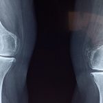 Ricerca, ecco i cerotti ultrasottili capaci di stimolare la rigenerazione dei tessuti