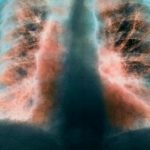 Coronavirus, problemi polmonari cronici per il 30% dei guariti