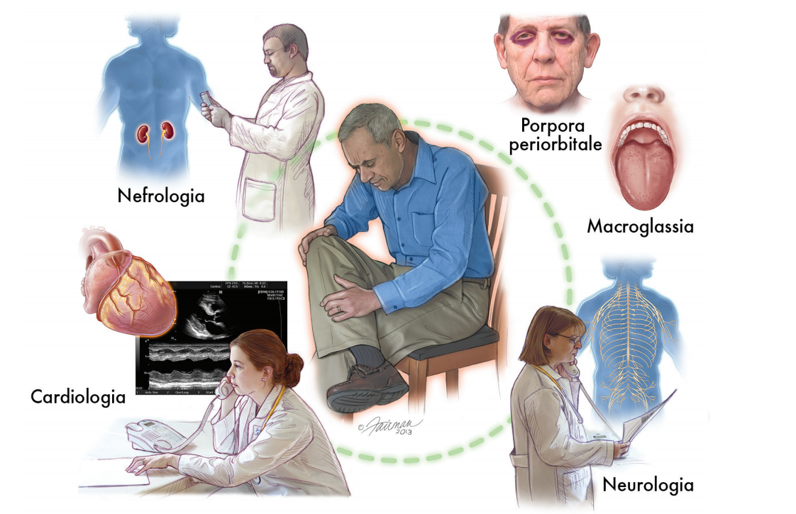 Amiloidosi, malattia rara che  in Sicilia colpisce più che nel resto d’Italia