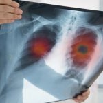 Tumore polmonare, progressi grazie alla nuova terapia mirata ensartinib