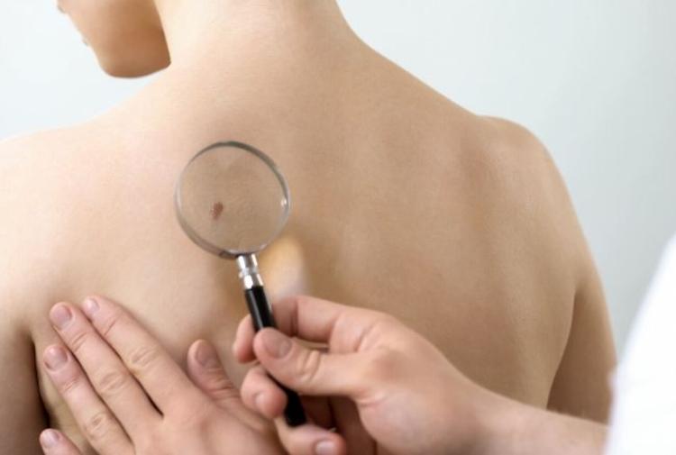 Salute, tumori della pelle in aumento, 10 regole per una diagnosi veloce
