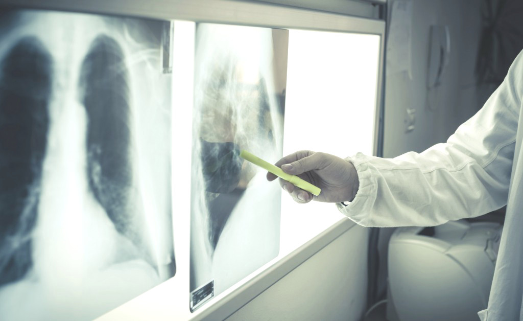 Tumori, in Sicilia 3mila nuovi al polmone, 340 a Messina