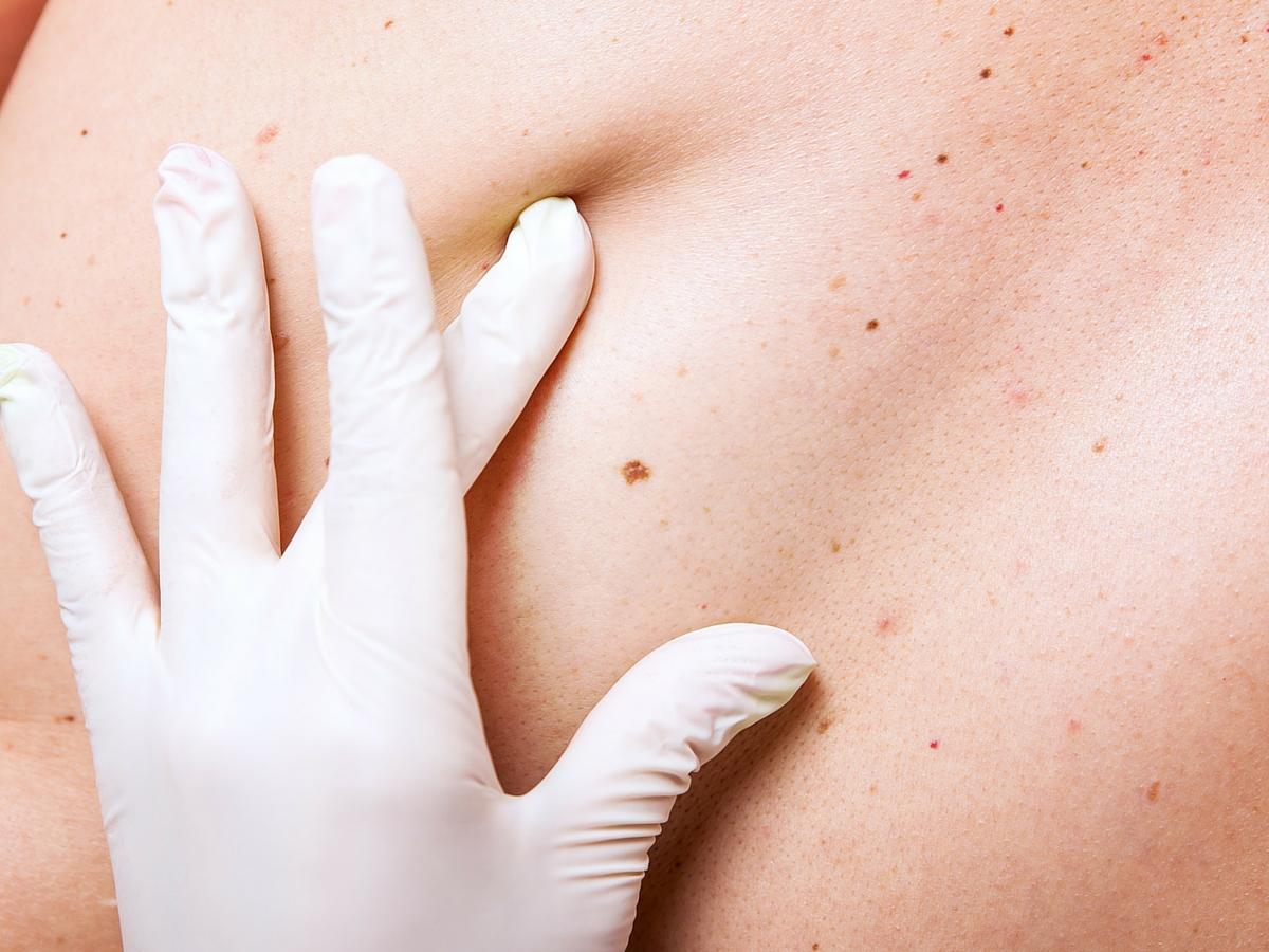 Imi “Il melanoma si può battere” servono prevenzione e giuste cure
