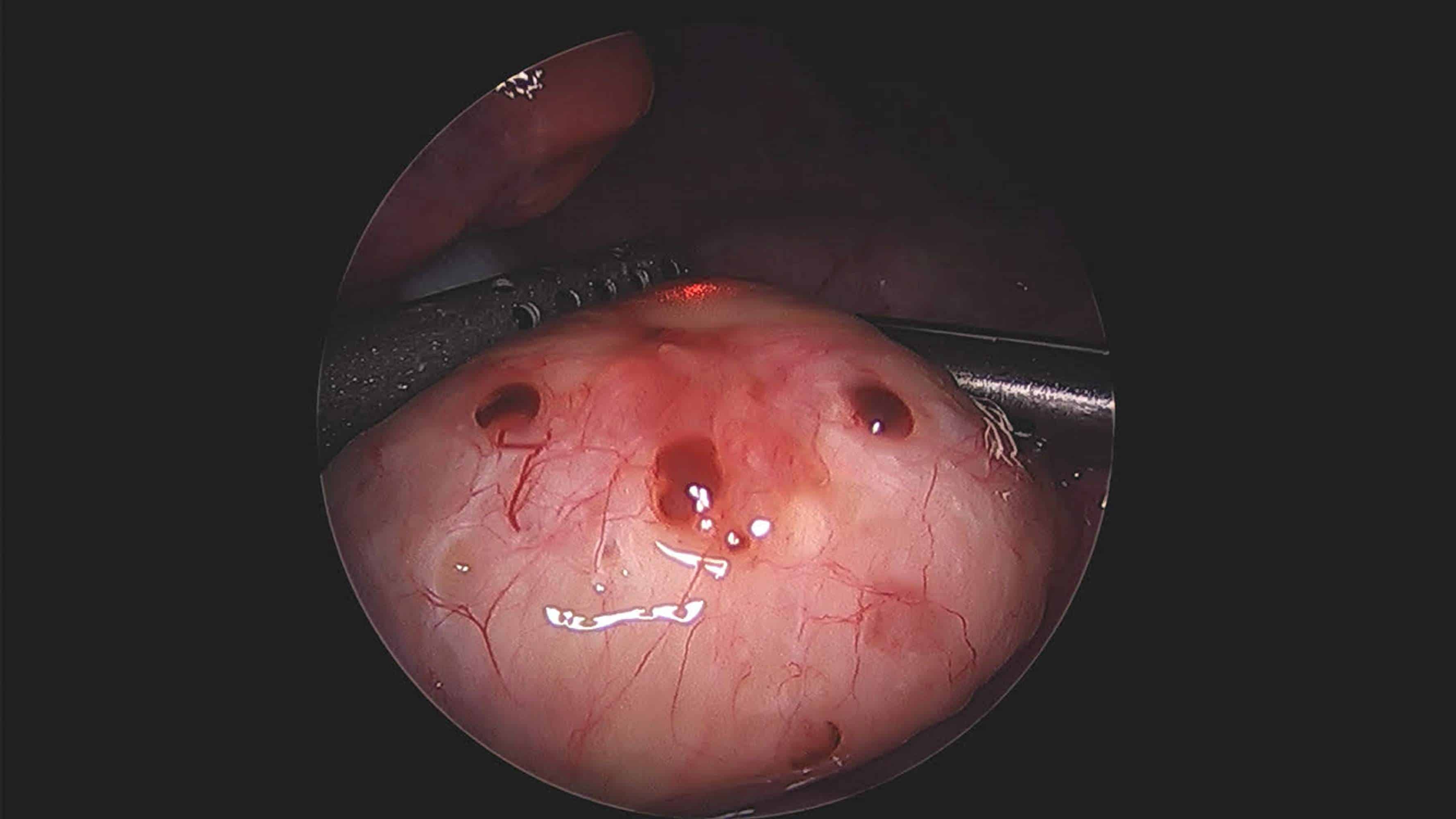 Endometriosi, diagnosi con otto anni di ritardo medio