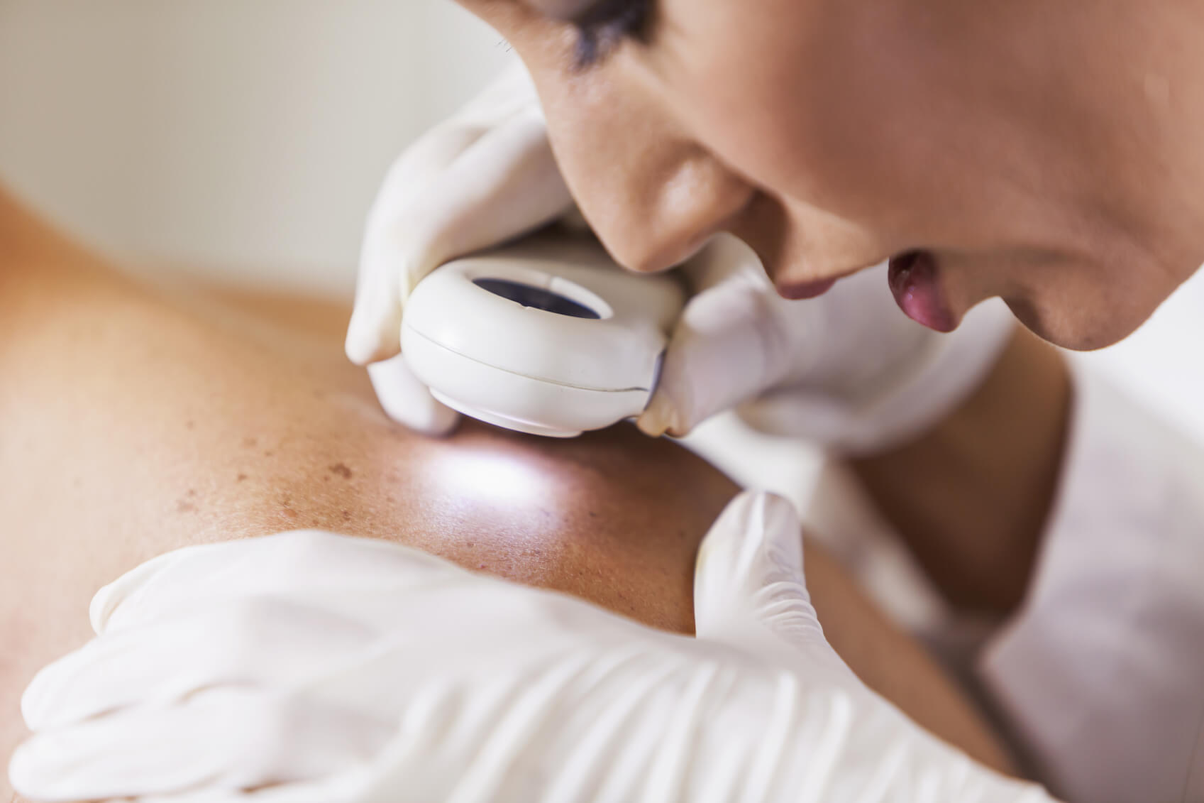 Prevenzione melanoma e Covid, controlli urgenti sempre possibili