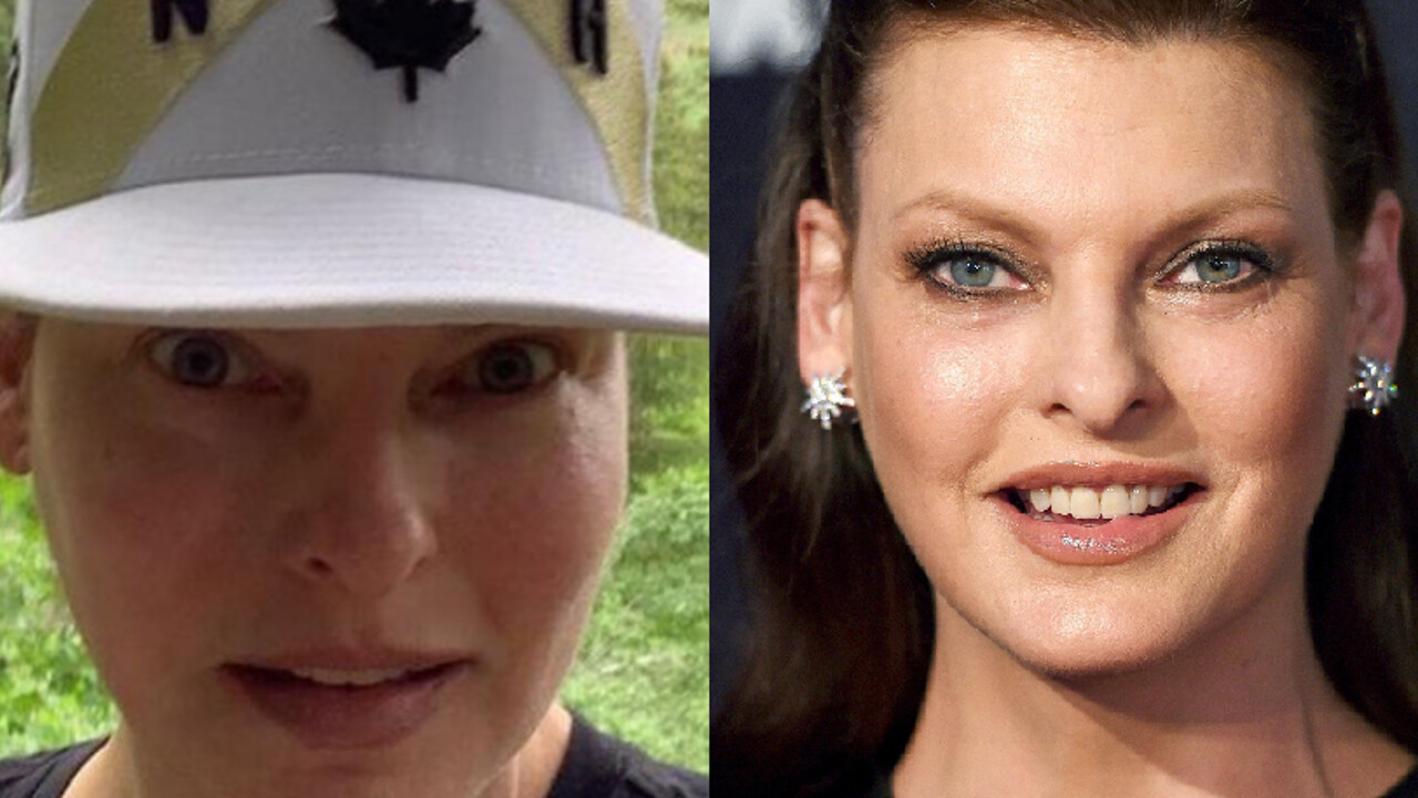 Linda Evangelista sfigurata  dalla criolipolisi, cos’è, effetti collaterali