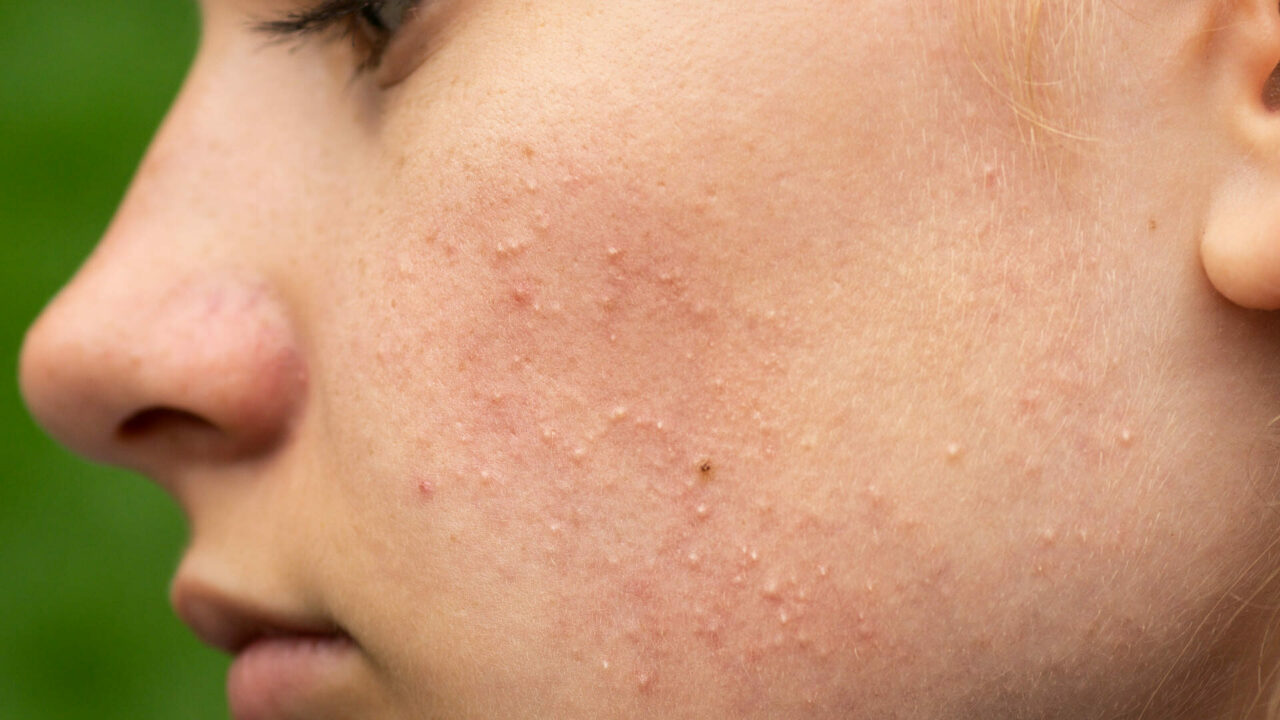 Acne in aumento a causa delle mascherine, come combatterla