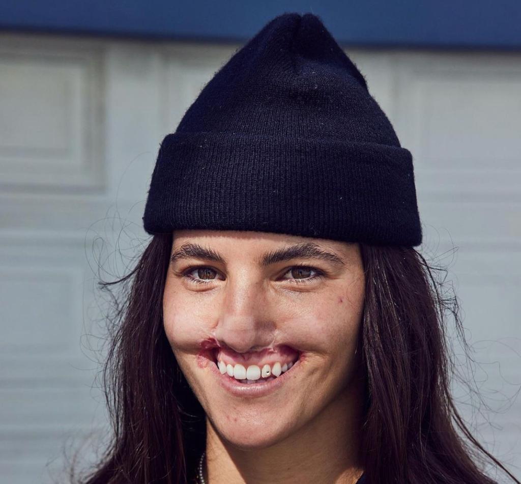 Modella sfigurata da pitbull, si sottoporrà a intervento da 400 mila dollari