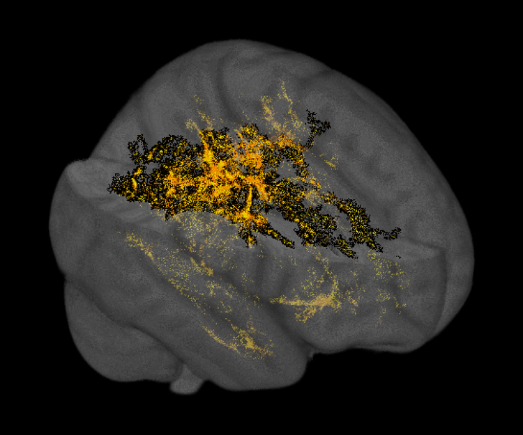 Covid, lo studio choc, “Dal virus molti danni al cervello”