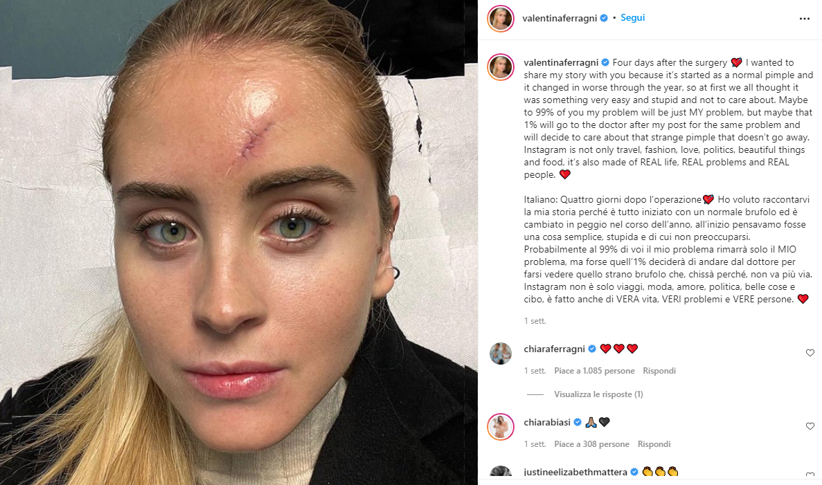 Il racconto di Valentina Ferragni: “Avevo un tumore maligno della pelle”