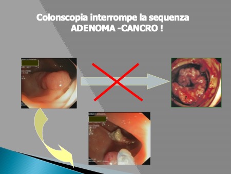 Tumore colon-retto: la migliore cura è la prevenzione