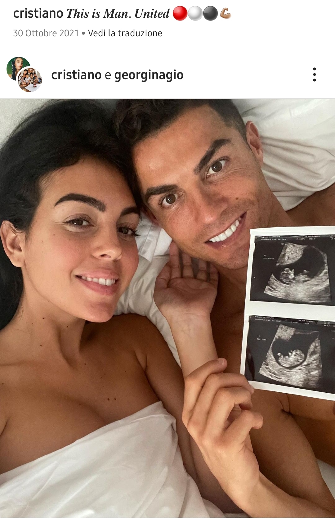 Dramma Ronaldo, morto uno dei due gemelli durante parto