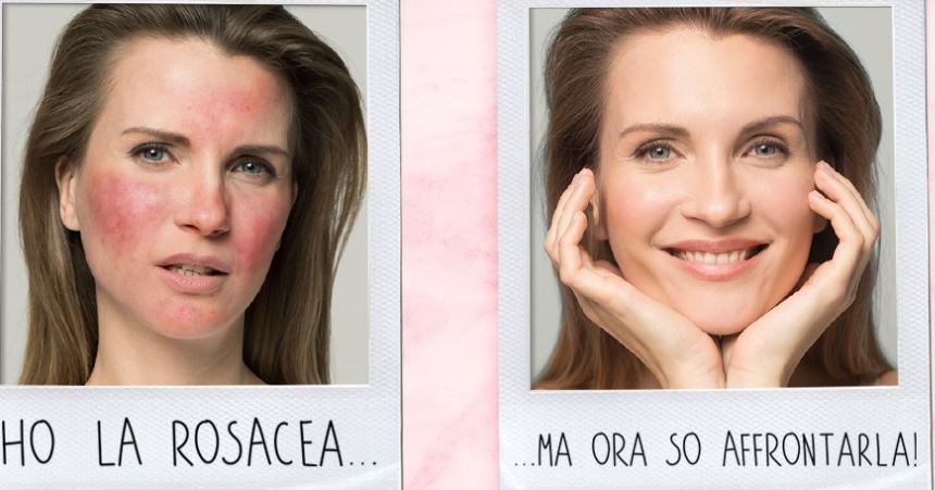 Rosacea, aprile mese dedicato alla malattia della pelle, cos’è, come si manifesta