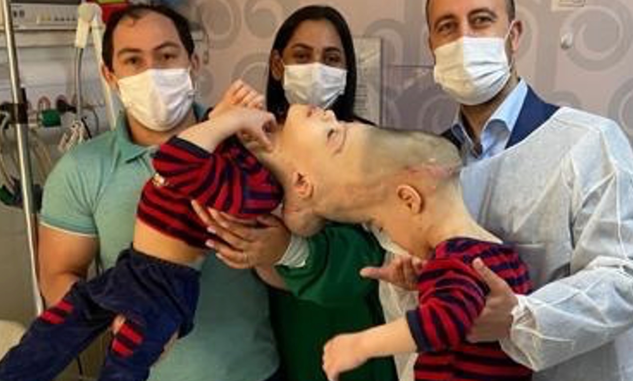 Brasile, separati due gemelli siamesi con i cervelli fusi