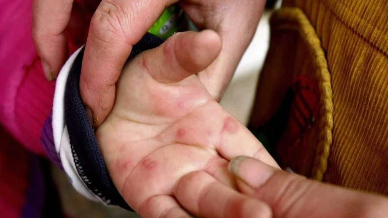 India, si diffonde “Influenza dei pomodori”: 80 casi accertati nei bambini under 5