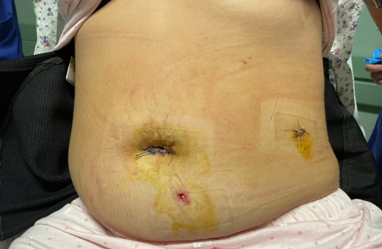 Policlinico Palermo, primo intervento per ernia ombelicale e diastasi dei muscoli retti con tecnica THT