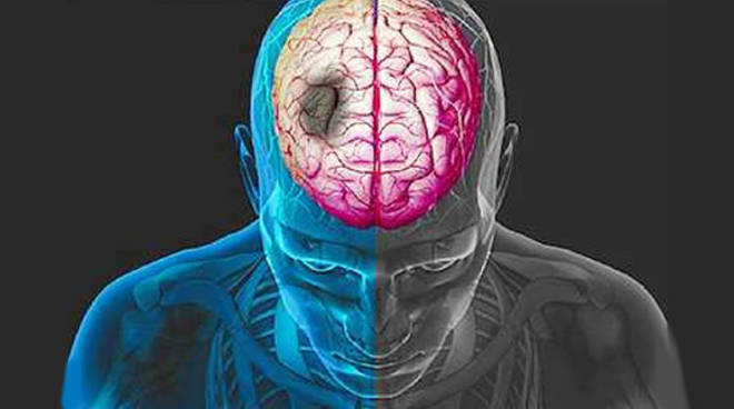 In Italia l’ictus colpisce ogni anno 150mila persone: incontro il 27 ottobre al Cefpas di Caltanissetta