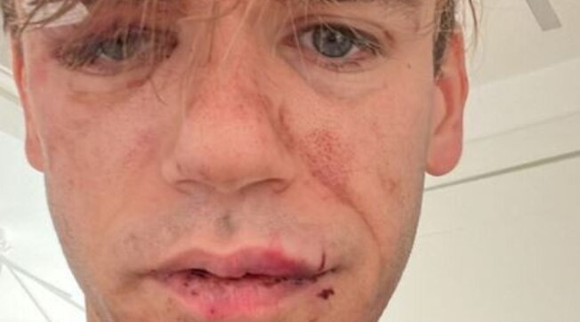 iPantellas, Jacopo Malnati picchiato e rapinato a Varese iPantellas, Jacopo Malnati picchiato e rapinato a Varese