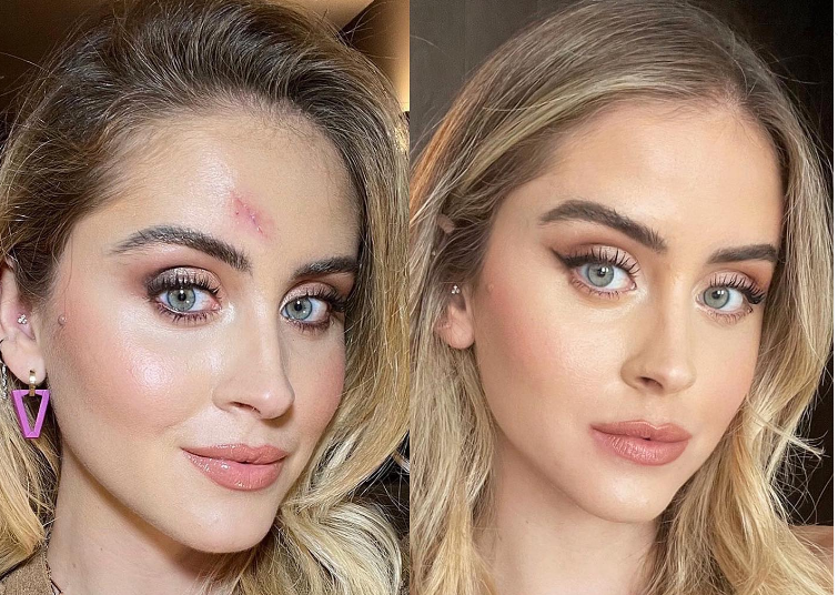 Valentina Ferragni, un anno dopo il carcinoma. Il  racconto sui social: “I medici salvano le vite”