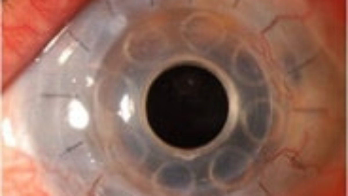 Primo trapianto di cornea artificiale in Italia: 76enne cieca recupera la vista