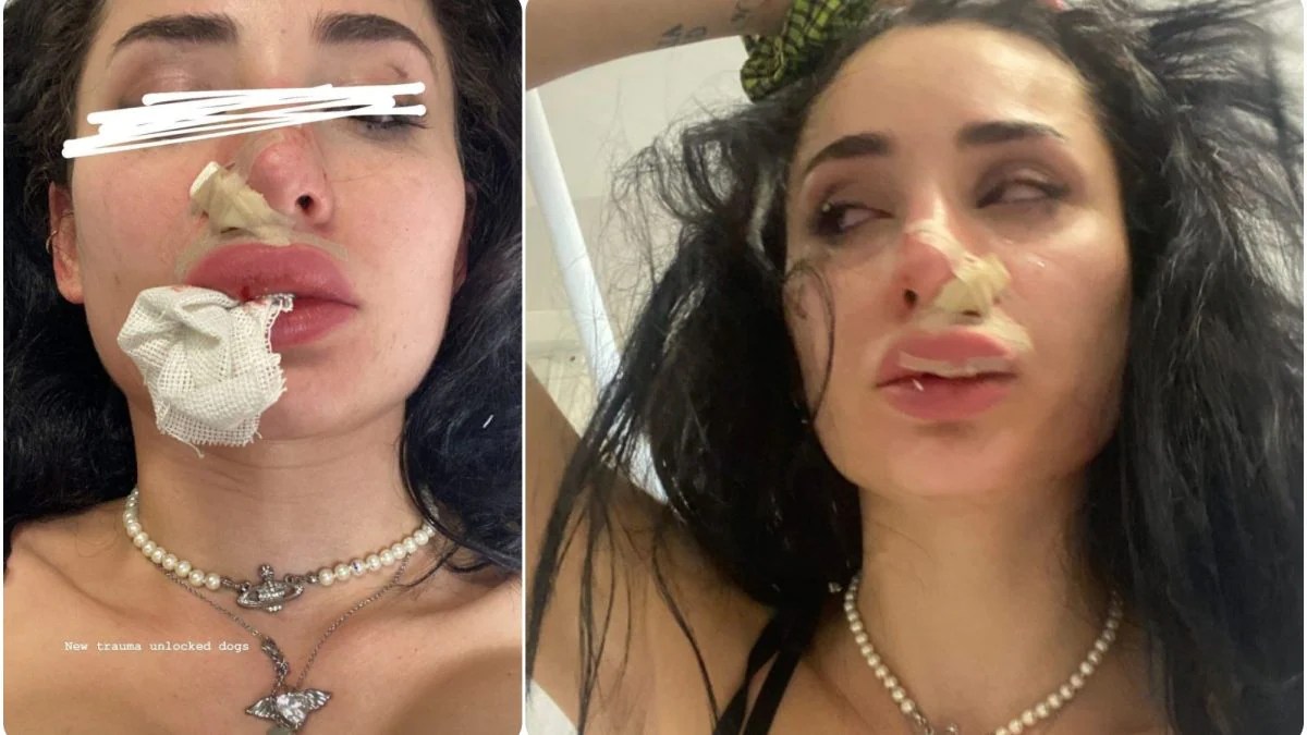 Greta Menchi aggredita e sfregiata da un cane: le foto choc