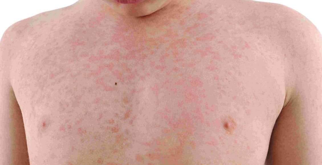 Batterio “killer” in Inghilterra: morti sei bambini per scarlattina