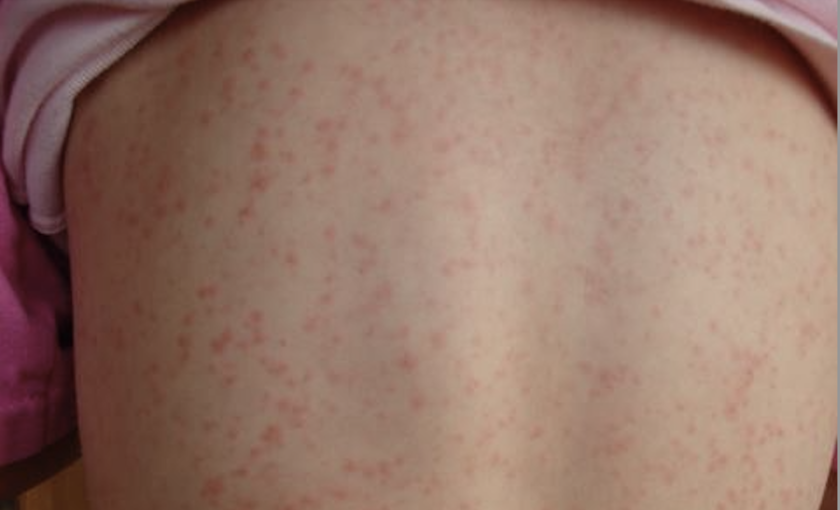 Scarlattina, boom di contagi tra i bambini: ecco i sintomi e come si trasmette