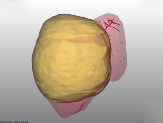 Medicina: rimosso tumore di 2 kg da fegato bimba di 2 mesi