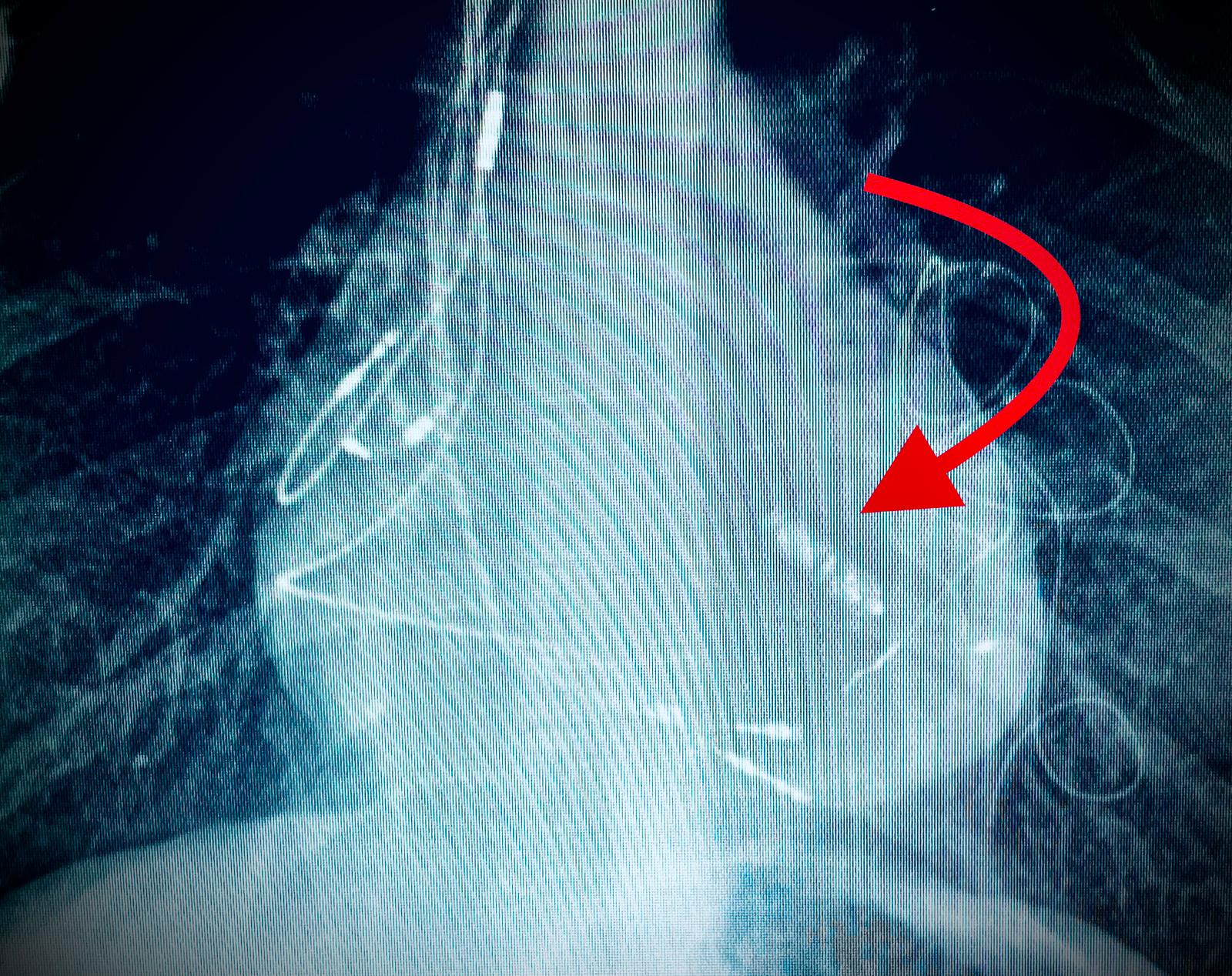 Pacemaker senza elettrodi: primo intervento al San Vincenzo di Taormina