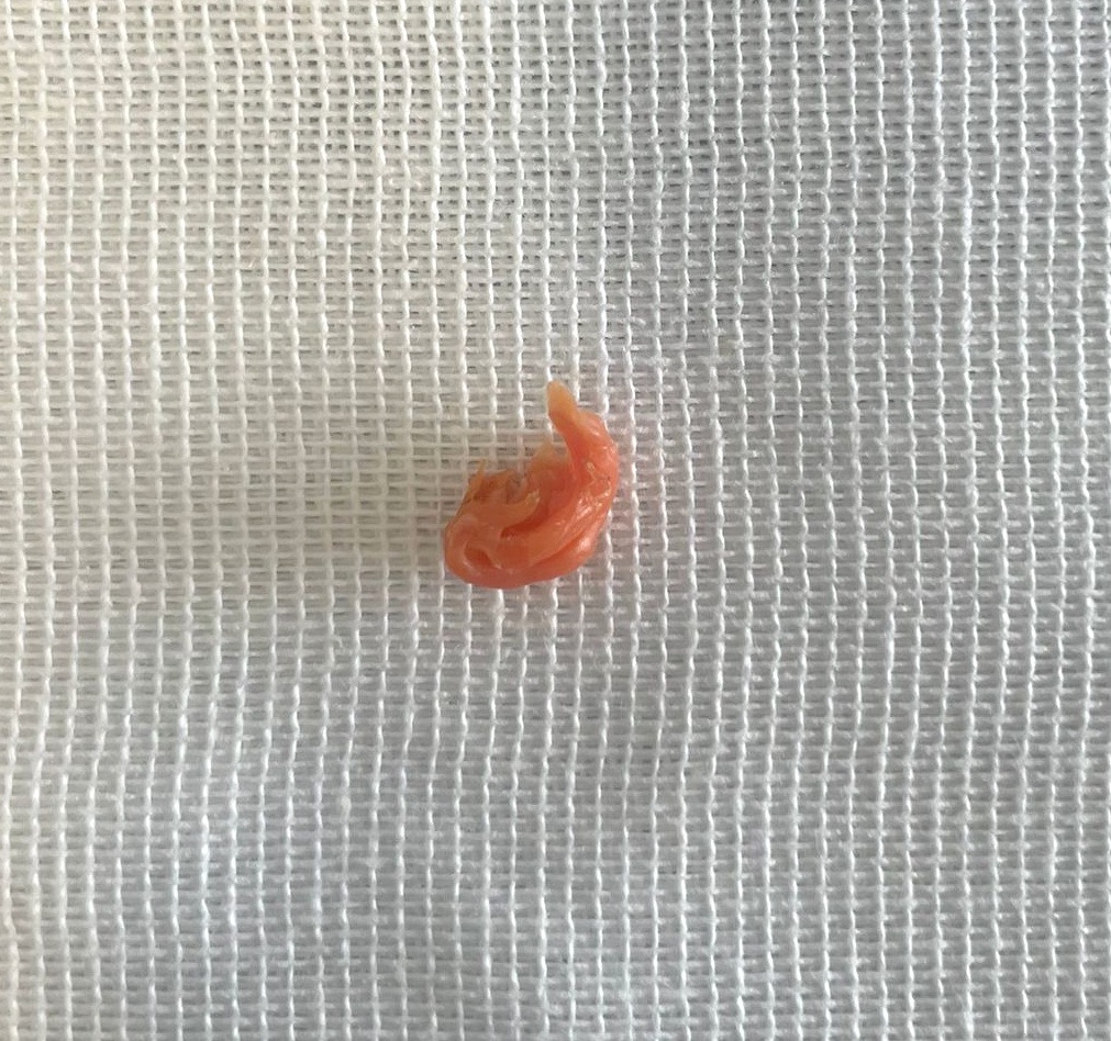 Catania, rischia di morire soffocato a 8 mesi: salvato in extremis