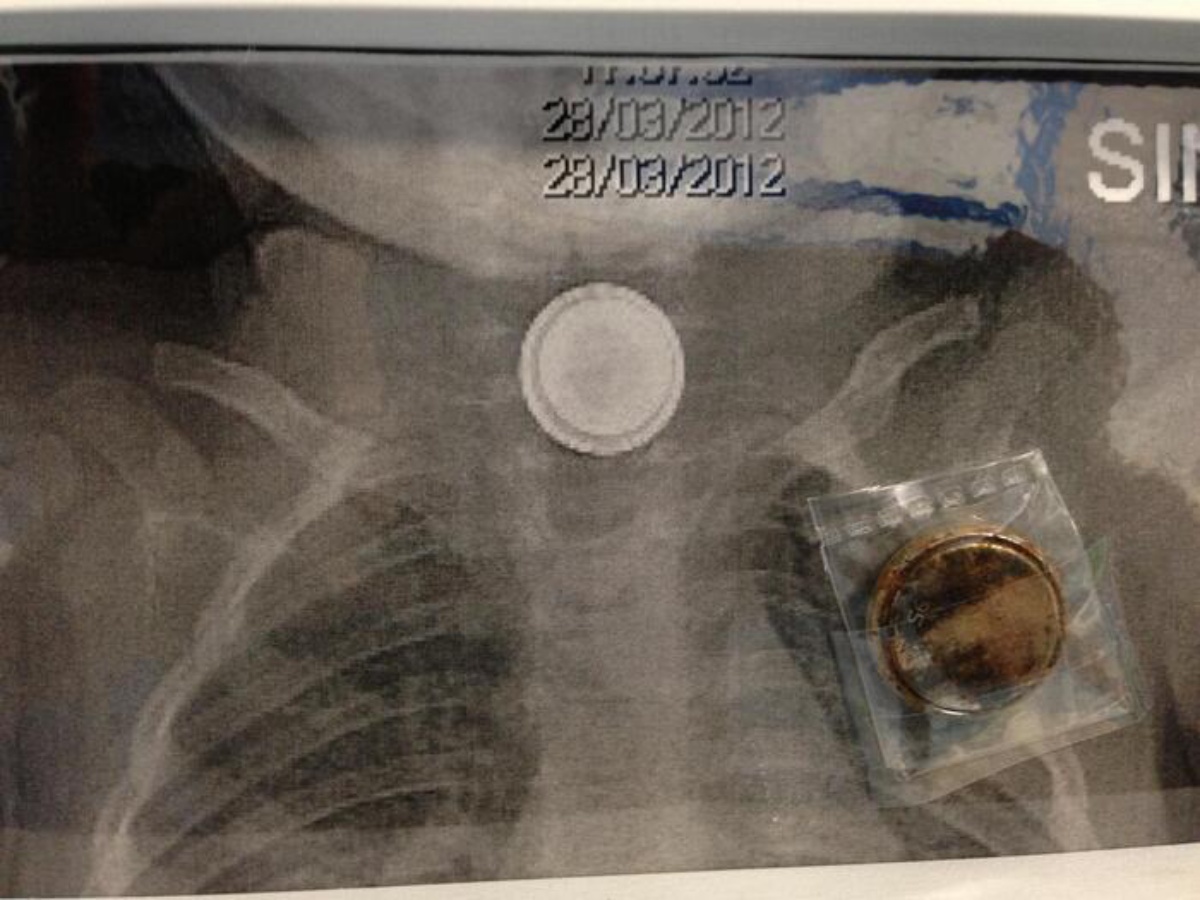 A 23 mesi ingerisce una pila e rischia di morire, salvata in extremis