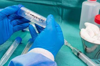 Ricerca, nella saliva 2 spie della demenza a corpi di Lewy, studio Sapienza